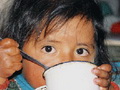 Undernourished child- Famine
